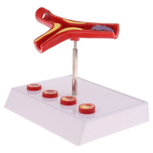 Modelo De Trombo Vascular Da Aterosclerose Em Vaso